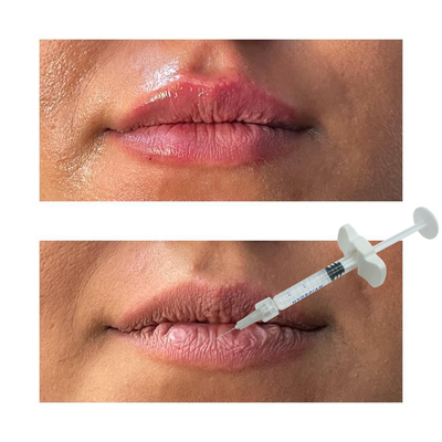 Nicht chirurgische Lippenverbesserungs-Füller-Hyaluronsäure-Lippeneinspritzungen