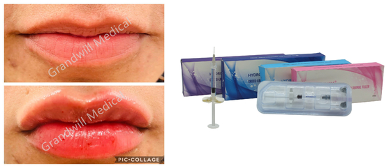 Hyaluronsäure Füllstoffe für Falten, Lippen, Brust, Gesäß