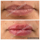 Hyaluronsäure Lippeninjektionen Natürliche Lippenfüllstoffe Nicht-chirurgische Lippenvergrößerung