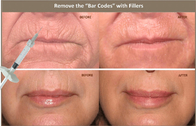 Hautfüller der injizierbaren Hyaluronsäure-10ml für die Korrektur von Gesichtsasymmetrie