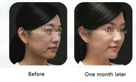 FÜLLER-Kollagen-Anreger Polycaprolactone Hautfür Gesichtsfalten-Behandlung