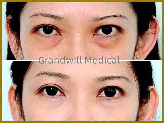 Hyaluronsäure-Gesichtsbehandlungs-Hautfüller für füllenden Träne-Abflussrinnen-Augen-Kreis