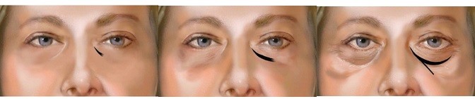 entfernen injizierbare Hyaluronsäure-Lösung 1ml 2ml mustert Augenringe-Behandlung
