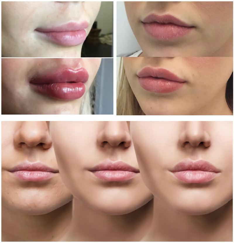 Glatte Linien/pralle Lippen mit Hyaluronsäure-injizierbarem Füller 1ml 2ml 5ml