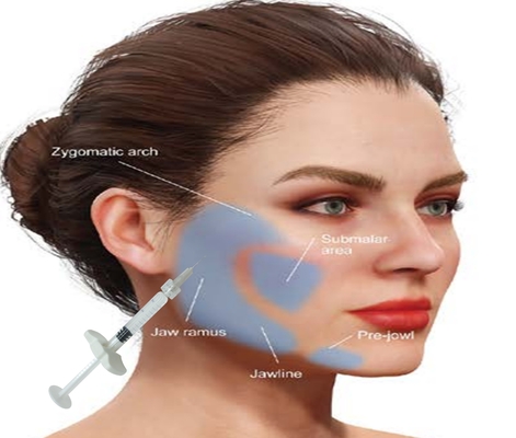 Hyaluronsäure HA Kalziumhydroxyapatit Füllmittel erhalten Sie ein natürlich aussehendes Gesicht mit einer 1 ml Spritze